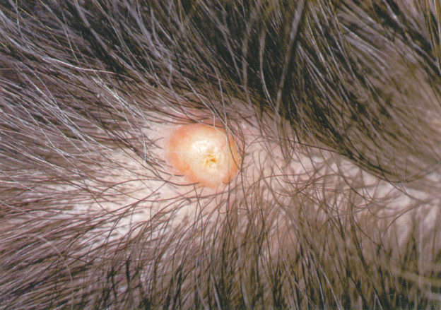 boils-on-scalp-causes-treatment-and-prevention-for-boils-on-your